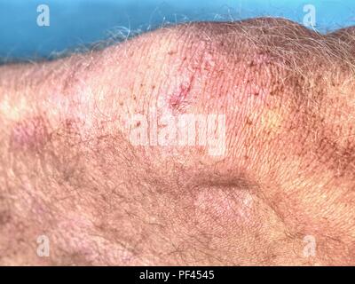 La cicatrice rosa sulla pelle umana. Cicatrice sul umano pelle bruciata dal abrassion scotti il fuoco selettivo Foto Stock