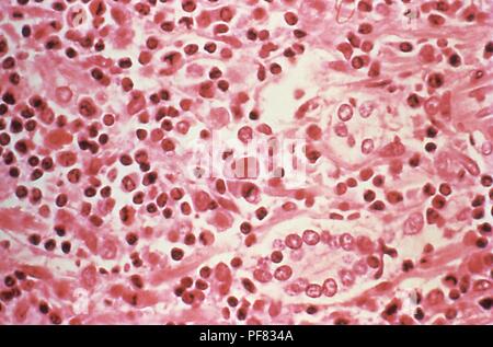 Il tessuto epatico ha rivelato nella micrografia immagine da un Hantavirus sindrome polmonare (HPS) paziente, 1994. Immagine cortesia di centri per il controllo delle malattie (CDC). () Foto Stock