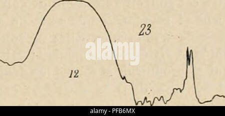 . Dictionnaire de physiologie. Fisiologia. La deglutizione. 7i5 ce sont les libres longitudinales dont la forte eontriiclion surmonte la rÃ©sistance des fibre musculaires et fait cesser l'occlusione. Â Â§ 4. Dcijlulitions rd'pdtccs. Â Tous les phÃ©nomÃ¨nes dÃ©crits jusqu'Ã prÃ©inviato se rap- avvisaglia Ã une dÃ©glutition isolÃ©e. iNous avons vu qu'en moins de 0",1 l'acte principal peut Ãªtre terminÃ©, que le bol est lancÃ© pendant cet intervalle de temps jusqu'au cardia. Nous savons Ã©galement qu'entre le premier mouvement et le inizio de la. Si prega di notare che queste immagini sono estratte dal Foto Stock