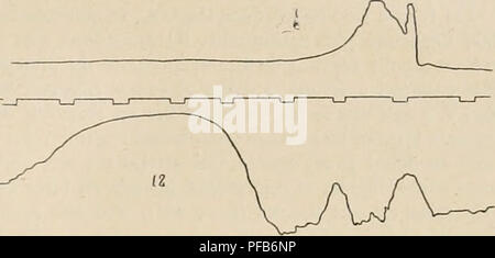 . Dictionnaire de physiologie. Fisiologia. La deglutizione. 735. FiG. 89. Â7. Dt'glutition d'une massa semi-liquide. Le tracÃ© supÃ©- rieur provient du pliarynx, l'infÃ©rieur est obtenu au moyen d'onu ballon enfoncÃ© Ã 12 centimÃ¨tres. La deuxiÃ¨me Ã©lÃ©vation provient de restes alimentaires renvoyÃ©s par le faringe. est imputabili Ã l'azione des constricteurs du pliarynx. Ce mode de progression du bol appartient aussi aux dÃ©glutitions isolÃ©es; mais il est incomparablement plus accusÃ© dans les dÃ©glutitions associÃ©es. Â" (p. 2o2) Arloing croit donc que la preniitre Ã©lÃ©vation du tracÃ© que nous Foto Stock