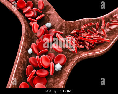 Anemia falciforme, 3D illustrazione che mostra il vaso sanguigno con il normale e deformato crescent Foto Stock