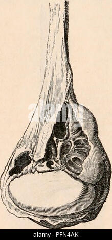 . Il encyclopaedia - Wikizionario di anatomia e fisiologia. Anatomia e fisiologia; Zoologia. 998 testicolo (Anatomia anormale). Essi costituiscono la forma di hydrocele, chiamato dalla sua sede originale, encysted hydrocele di epididimo. Ho osservato questa descrizione di hydrocele in tutte le sue varie modifiche, dall'ampliamento semplicemente di una singola cisti della complicazione causate dalle variazioni di de- velopment di diversi. Come una ciste ingrandisce l'epididimo diventa appiattita, e spostato verso un lato, mentre il testicolo si trova davanti o sul fondo. Talvolta è a lato, ma raramente al Foto Stock