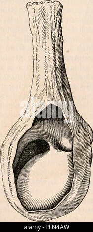 . Il encyclopaedia - Wikizionario di anatomia e fisiologia. Anatomia e fisiologia; Zoologia. 996 testicolo (Anatomia anormale). renza di hydrocele tunica vaginalis può essere stato infiammato e contratto aderenze, in modo che il testicolo può essere collegato alla membrana di fronte; nel qual caso il siero si accumula su ciascun lato o al di sopra e al di sotto dell'organo. La posizione del testicolo di fronte può essere anche a causa di un originale inversione dell'organo, in cui la libera sur- faccia presentando all'indietro, il fluido si raccoglie in quella direzione e preme il testicolo verso la parte anteriore del sacco. A volte ci sono severa Foto Stock