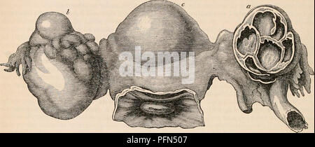 . Il encyclopaedia - Wikizionario di anatomia e fisiologia. Anatomia e fisiologia; Zoologia. 580 utero e le sue appendici. presentante una sezione di più semplice cisti di organo essendo ancora aperti, che esibisce quasi uguale dimensione ; mentre l'ovaia sinistra (6) numerose piccole sacculi che qui ha iniziato mostra una analoga alterazione delle texture, il progetto al di sopra della superficie. Fly. 393.. a, ovaia destra, che presenta numerose unilocular cisti, costituito da ingrandita vescicole Graaflan; 6 Ovaia sinistra similmente influenzata, ma aperti ; c, utero. (Dopo Hooper.) Midlilocular, composto, o Proliferous cisti. -In questi un Foto Stock