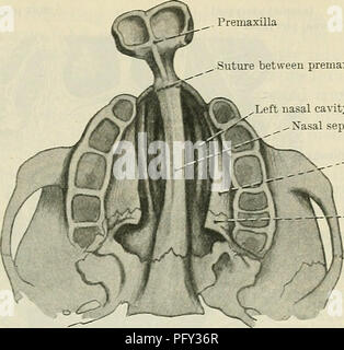 . Cunningham il libro di testo di anatomia. Anatomia. -Il volto. 1381 sutura tra premaxilla e vomer lasciato nella cavità nasale ., Xasal setto. Processo palatino della mascella .piastra orizzontale del palato osso Fig. 1082. - Mostra la disposizione delle ossa in doppia Palatoschisi {Handbook di chirurgia pratica, Bergmann, crusche e Mikulicz). vomer (Fig. 1082). Se la proiezione premaxillary essere rimosso completamente, non vi è nulla di sinistra per sostenere il labbro superiore, e il risultato è un brutto deformità, a causa della sporgenza di confronto e la ridondanza del labbro inferiore. /^^k f 1£   . Denti Premaxilla. -I denti di latte iniziare Foto Stock