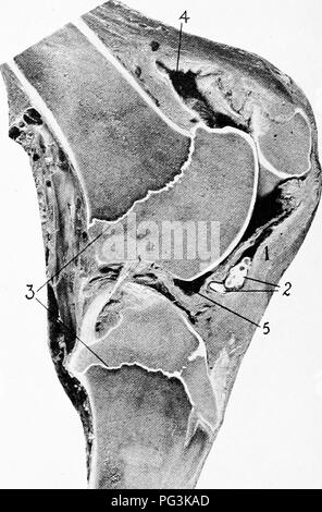 . Il cavallo nella salute e nella malattia : un libro di testo relative alle scienze veterinarie per studenti agricoli . Cavalli; cavalli. 212 IL IIOHSE nella salute e nella malattia stesso tempo sollevare la rotula verso l'alto con entrambe le mani. Si sentirà un clic quando l'osso shps torna in posizione. Dopo-. Fig. 61.-Di.sieased lasciato soffocare giunto; sezione sagittale passando attraverso la nervatura interna della troclea della piega fennir: 1, ispessita della membrana sinoviale di capsula articolare; 2, libera i corpi di giunzione; ','}, epipliyseal hnes; 4, prolunga superiore del giunto femoropatellar cavità; '), ABBASSARE I'coperchio della stessa. trattamento consiste nell'applicat Foto Stock