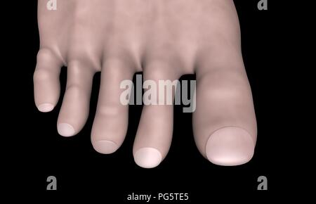 Toe nail dopo infezione fungina di trattamento. Una sana toenail. 3D render Foto Stock