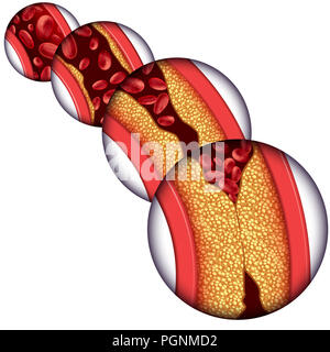 Arteria coronaria malattia malattia come un concetto medico con graduale formazione di placca risultante in arterie intasate e aterosclerosi. Foto Stock