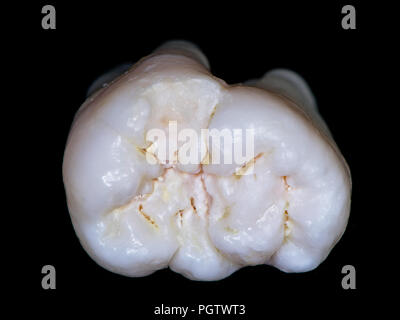 Dente di saggezza, inferiore sinistro molare, extra large, due denti in una fusione o gemination concrescentio? Foto Stock