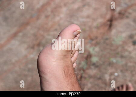 Primo piano di un piede umano e le dita dei piedi con incrinato e spellatura unghie dei piedi. Foto Stock