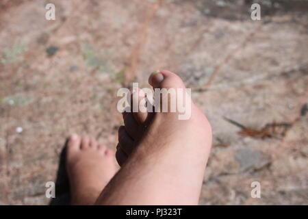 Primo piano di un piede umano e le dita dei piedi con incrinato e spellatura unghie dei piedi. Foto Stock