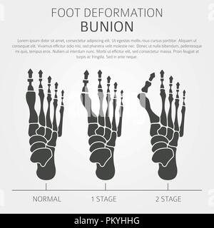 La deformazione del piede come malattia medica ed infografico. Cause di bunion. Illustrazione Vettoriale Illustrazione Vettoriale