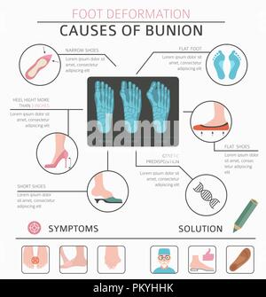 La deformazione del piede come malattia medica ed infografico. Cause di bunion. Illustrazione Vettoriale Illustrazione Vettoriale