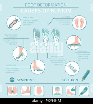 La deformazione del piede come malattia medica ed infografico. Cause di bunion. Illustrazione Vettoriale Illustrazione Vettoriale