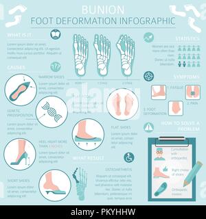 La deformazione del piede come malattia medica ed infografico. Cause di bunion. Illustrazione Vettoriale Illustrazione Vettoriale