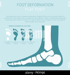 La deformazione del piede come malattia medica ed infografico. Cause di piede piatto. Illustrazione Vettoriale Illustrazione Vettoriale