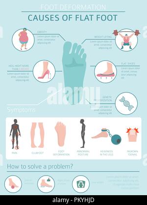 La deformazione del piede come malattia medica ed infografico. Cause di piede piatto. Illustrazione Vettoriale Illustrazione Vettoriale