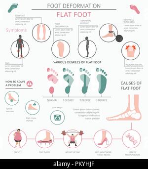 La deformazione del piede come malattia medica ed infografico. Cause di piede piatto. Illustrazione Vettoriale Illustrazione Vettoriale