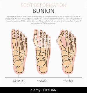 La deformazione del piede come malattia medica ed infografico. Cause di bunion. Illustrazione Vettoriale Illustrazione Vettoriale