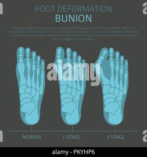 La deformazione del piede come malattia medica ed infografico. Cause di bunion. Illustrazione Vettoriale Illustrazione Vettoriale