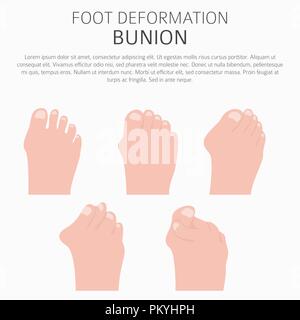 La deformazione del piede come malattia medica ed infografico. Cause di bunion. Illustrazione Vettoriale Illustrazione Vettoriale