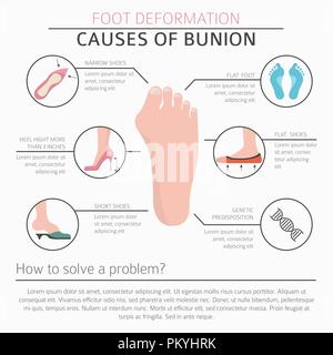 La deformazione del piede come malattia medica ed infografico. Cause di bunion. Illustrazione Vettoriale Illustrazione Vettoriale