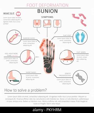 La deformazione del piede come malattia medica ed infografico. Cause di bunion. Illustrazione Vettoriale Illustrazione Vettoriale