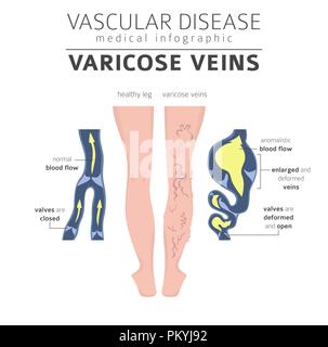 Malattie vascolari. Vene varicose sintomi, trattamento icon set. Infografico medica design. Illustrazione Vettoriale Illustrazione Vettoriale