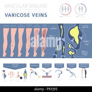 Malattie vascolari. Vene varicose sintomi, trattamento icon set. Infografico medica design. Illustrazione Vettoriale Illustrazione Vettoriale