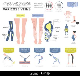 Malattie vascolari. Vene varicose sintomi, trattamento icon set. Infografico medica design. Illustrazione Vettoriale Illustrazione Vettoriale