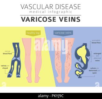 Malattie vascolari. Vene varicose sintomi, trattamento icon set. Infografico medica design. Illustrazione Vettoriale Illustrazione Vettoriale