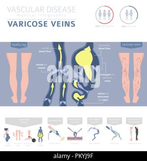 Malattie vascolari. Vene varicose sintomi, trattamento icon set. Infografico medica design. Illustrazione Vettoriale Illustrazione Vettoriale