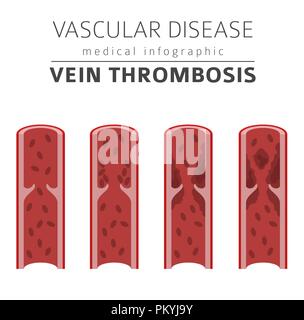 Malattie vascolari. Trombosi della vena sintomi, trattamento icon set. Infografico medica design. Illustrazione Vettoriale Illustrazione Vettoriale