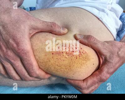 Grande e colorata livido sul corpo umano. Hurt doloroso luogo dopo incidente sportivo. Dettaglio del corpo maschio. Dolorosa per via sottocutanea il pregiudizio sulla pelle umana Foto Stock