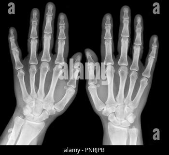 X-ray immagine medica - umani palms Foto Stock