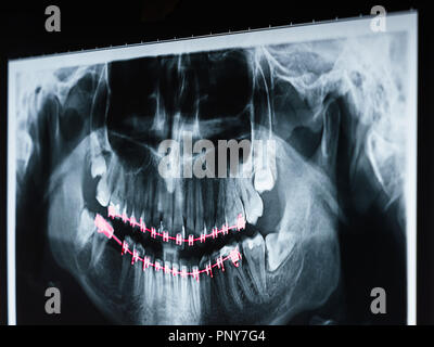 Apparecchiature odontoiatriche a raggi X e la foto del teschio umano e i denti con le bretelle Foto Stock