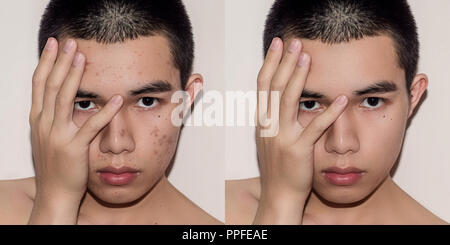 Giovane con prima e dopo il trattamento di acne e brufolo, prima e dopo della pelle del viso Trattamento da cicatrici e rughe da acne distacco. Macchie pelle b Foto Stock