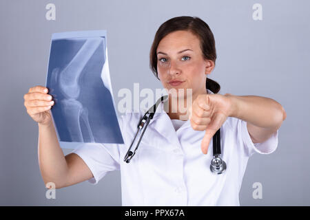 Ritratto di un giovane medico donna con il ginocchio X-ray gesticolando il pollice verso il basso Foto Stock