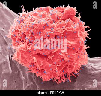 HIV cellule infettate. Color scanning electron microfotografia (SEM) di una cellula 293T infettate con il virus di immunodeficienza umana (HIV, puntini rossi). Sferiche piccole particelle di virus, visibile sulla superficie, sono in fase di germogliamento dalla membrana cellulare. Qualsiasi non evidenza vescicole di forma irregolare sono exosomes, pensato per essere coinvolti nella cella di comunicazione e di trasmissione di malattie e sotto inchiesta come un mezzo di erogazione del farmaco. Ingrandimento: x6600 a 10cm. Modello di cortesia di Greg torri, University College di Londra, Regno Unito. Foto Stock