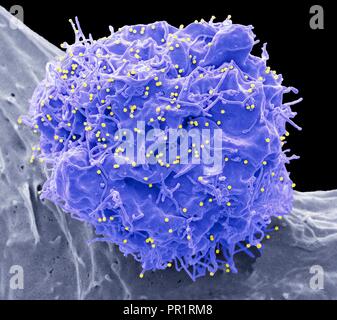 HIV cellule infettate. Color scanning electron microfotografia (SEM) di una cellula 293T infettate con il virus di immunodeficienza umana (HIV, puntini rossi). Sferiche piccole particelle di virus, visibile sulla superficie, sono in fase di germogliamento dalla membrana cellulare. Qualsiasi non evidenza vescicole di forma irregolare sono exosomes, pensato per essere coinvolti nella cella di comunicazione e di trasmissione di malattie e sotto inchiesta come un mezzo di erogazione del farmaco. Ingrandimento: x6600 a 10cm. Modello di cortesia di Greg torri, University College di Londra, Regno Unito. Foto Stock