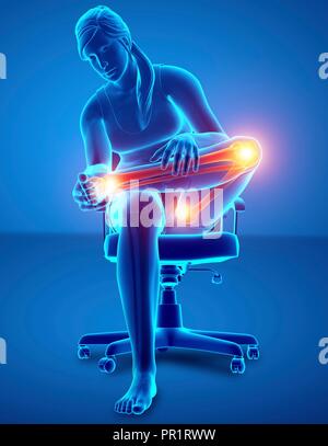 Donna con dolore alle gambe, illustrazione del computer. Foto Stock