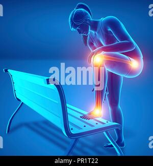 Donna con dolore alle gambe, illustrazione del computer. Foto Stock