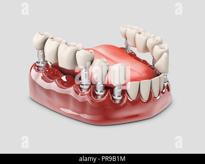 3d illustrazione di un parziale fisso di dentiera bridge, Isolato bianco. Foto Stock