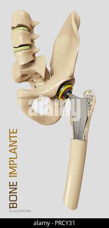 Articolazione anca Sostituzione, articolazione artificiale 3d illustrazione Foto Stock