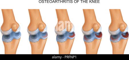 Illustrazione vettoriale di osteoartrite del ginocchio Illustrazione Vettoriale
