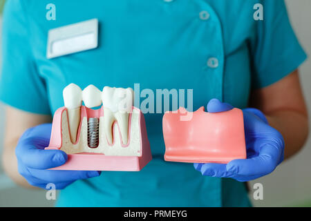 Le mani del dentista tenere una breadboard modello del dente con un impianto Foto Stock