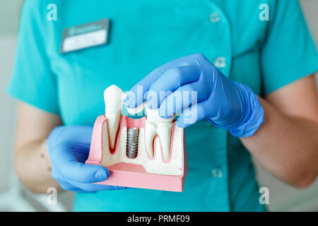 Le mani del dentista tenere una breadboard modello del dente con un impianto Foto Stock