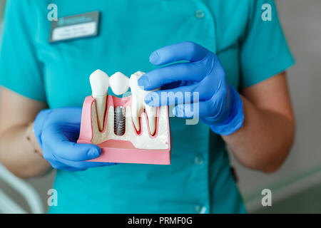 Le mani del dentista tenere una breadboard modello del dente con un impianto Foto Stock