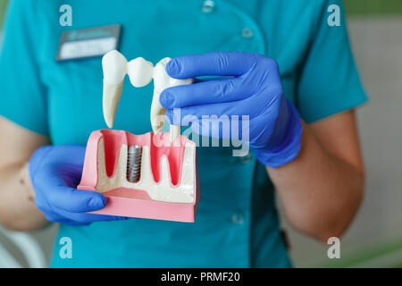 Le mani del dentista tenere una breadboard modello del dente con un impianto Foto Stock