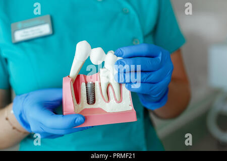 Le mani del dentista tenere una breadboard modello del dente con un impianto Foto Stock